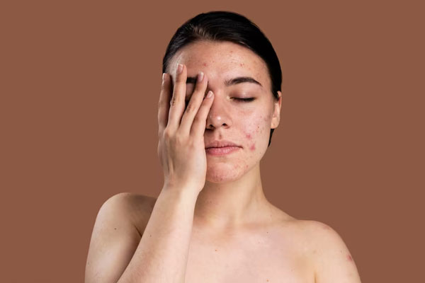 Mujer con problemas de acné en el rostro