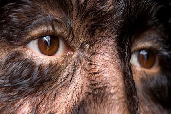 Hipertricosis - Plano detalle de los ojos de una niña con exceso de vello en el rostro por síndrome del hombre lobo