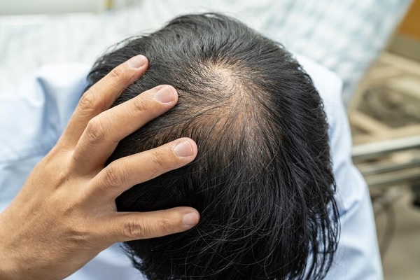 Implante capilar a los 50 - Plano detalle de la cabeza de un hombre con alopecia en la coronilla