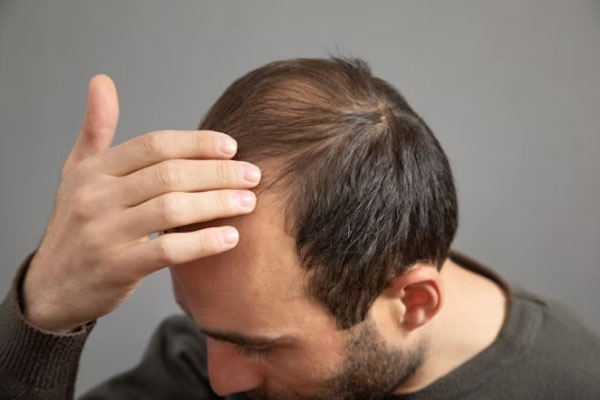 Implante capilar a los 50 - Hombre con problemas de alopecia pasa su mano por la cabeza