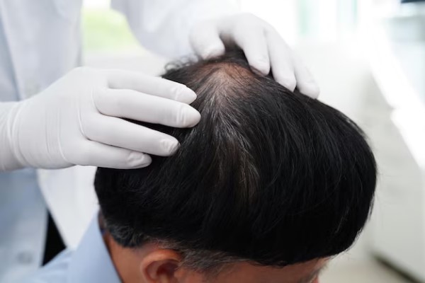 grados de alopecia - Hombre en la consulta del tricólogo revisando el avance de la alopecia en la zona de la coronilla