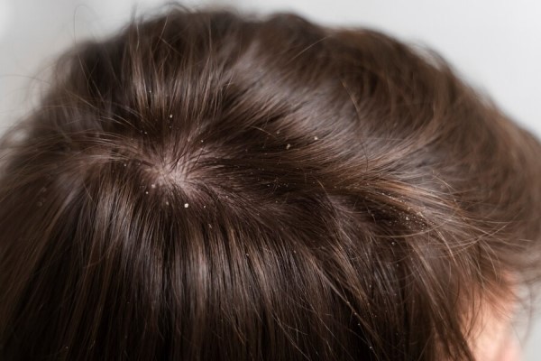 Alopecia Seborreica - parte alta de la cabeza de paciente con caspa en el cuero cabelludo