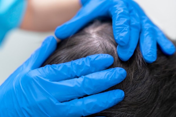 Alopecia Seborreica - especialista revisando el cuero cabelludo de un paciente en su consulta