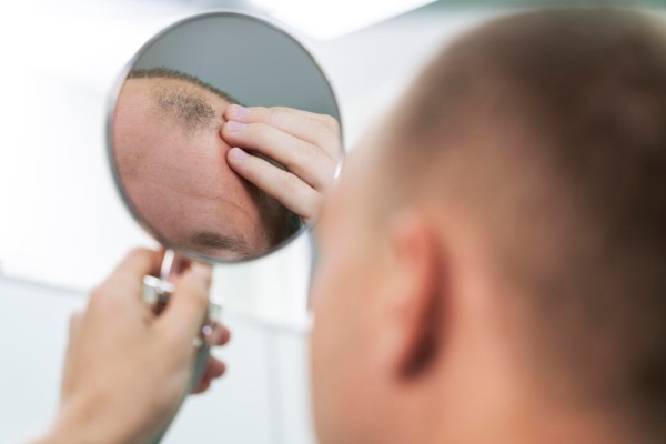 grados de alopecia - hombre revisando en el espejo el avance de la alopecia androgénica en su cabello