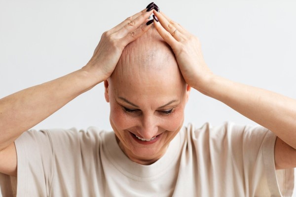 grados de alopecia - Mujer pasando las manos por su cabeza sin cabello por culpa de la alopecia