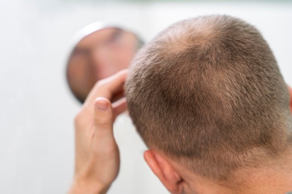 alimentos que causan la caída del cabello - hombre revisando en el espejo como avanza la alopecia en su cabello