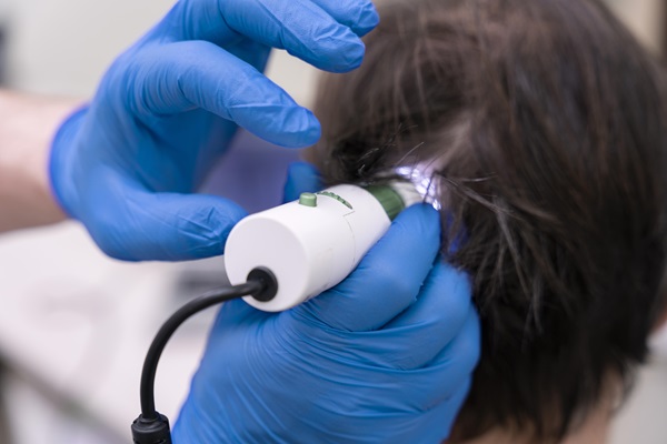 Médico usa un instrumento capilar para evaluar el cuero cabelludo de un hombre