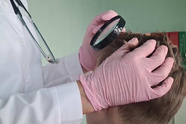Diagnosticar la alopecia - Médico especialista usa una lupa para evaluar el cuero cabelludo de un hombre