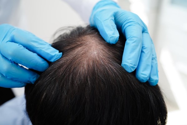 injerto capilar - tricólogo revisando la zona de implante capilar donde hay una calva tras la caída del cabello