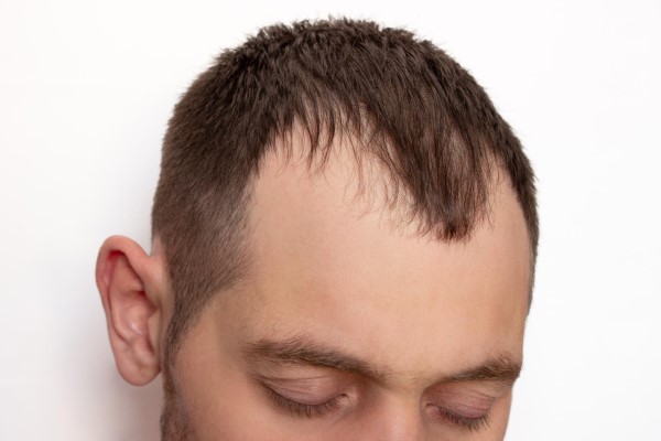cabeza de un hombre joven con una alopecia avanzada en la línea del cabello y las entradas