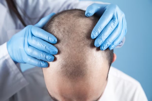 hombre en la consulta del tricólogo con signos de una alopecia androgénica avanzada