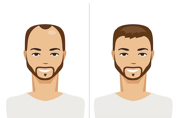 Sistema de integración capilar - Ilustración del antes y del después de un hombre con prótesis capilar