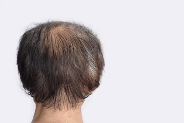 genes causantes de la alopecia - mujer de espaldas con claros problemas de alopecia