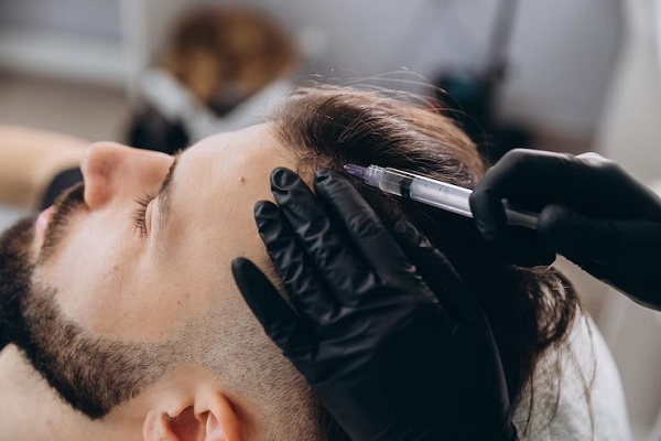 Infiltración capilar - Joven se somete a un tratamiento de mesoterapia para frenar la caída del cabello