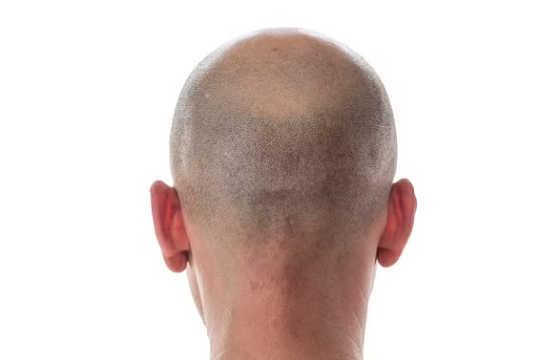 Pacientes no aptos para injerto capilar - Vista posterior de la cabeza de un hombre con problemas de alopecia