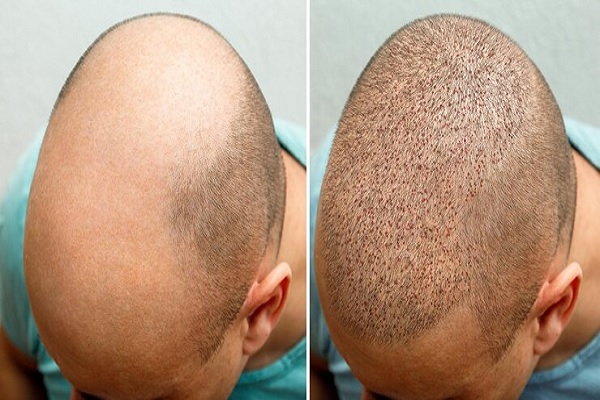 duele el injerto capilar - imagen de un paciente con graves problemas de alopecia antes y después de un injerto capilar