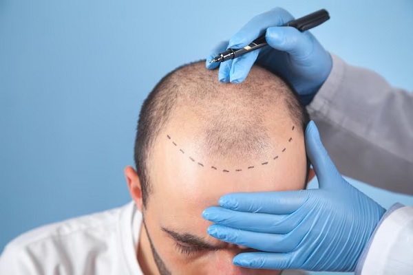 paciente en la consulta del especialista mientras este diseña el implante de cabello en su cabeza