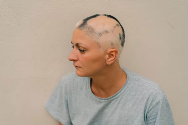 Olumiant - Mujer con alopecia areata experimenta una pérdida de cabello en parches redondos