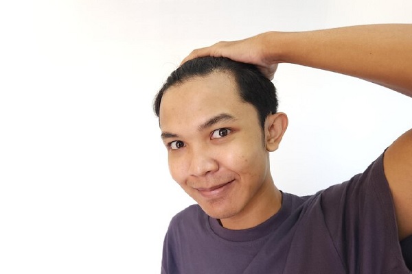 Alopecia prematura - Joven busca soluciones para frenar y ralentizar la caída del cabello