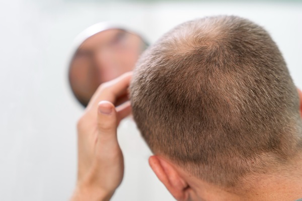 Granos en la cabeza - Hombre con alopecia observando en un espejo el avance del implante de cabello