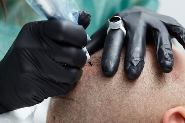 Pacientes no aptos para injerto capilar - Tatuador profesional realiza una micropigmentación capilar para mejorar la apariencia de un hombre con alopecia