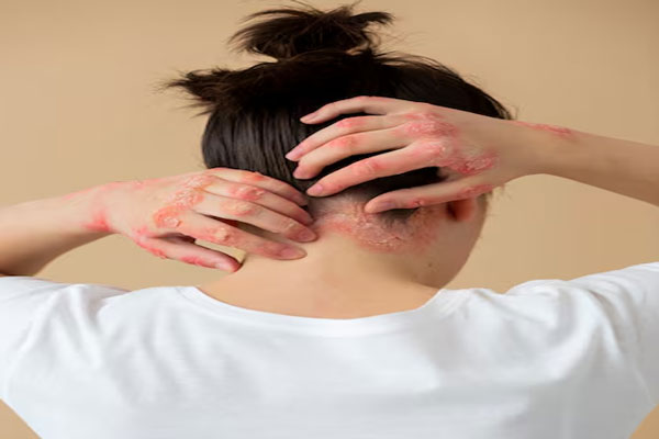 Pacientes no aptos para injerto capilar - Vista trasera del cuero cabelludo de una joven con psoriasis