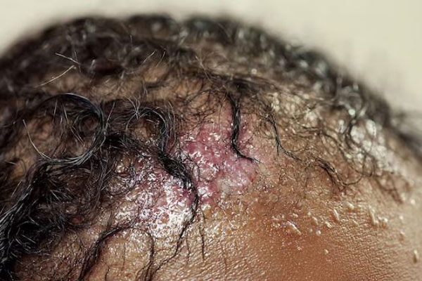 Foliculitis decalvante - Primer plano de un cuero cabelludo inflamado y con lesiones a consecuencia de una afección capilar