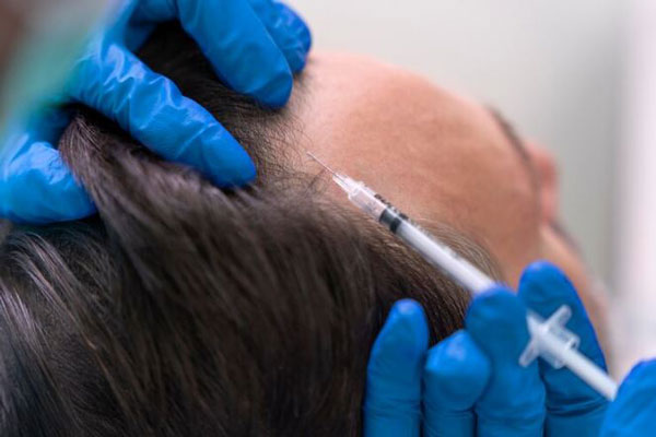 Clonación capilar - Cirujano realiza la extracción de unidades foliculares para llevar a cabo un trasplante de cabello 