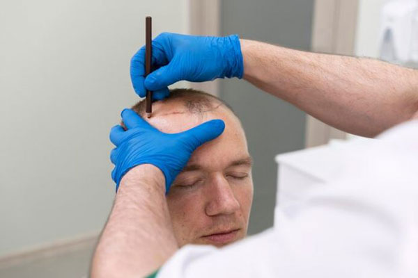 Clonación capilar - Cirujano trabaja en el diseño de un trasplante de cabello para mejorar la apariencia de un hombre con alopecia 