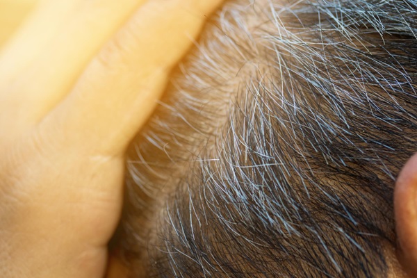 Síndrome de Waardenburg - Persona pasando su mano por el cabello con mechones de color blanco característico de la enfermedad de Waardenburg