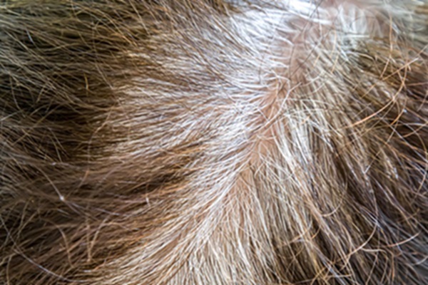 Persona con canas prematuras en el cabello debido al desarrollo de una enfermedad genética