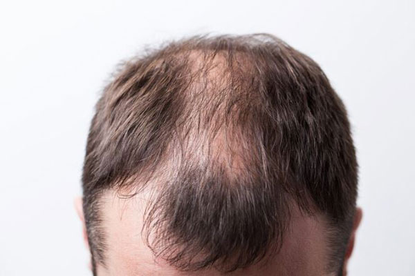 Alopecia prematura - Primer plano de claros en el cuero cabelludo y de zonas calvas en la cabeza de un hombre joven