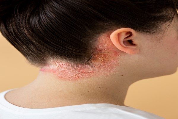 mujer con claros signos de estar sufriendo psoriasis capilar