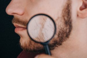 Injerto de barba - Hombre usando una lupa para observar el vello facial que comienza a crecer luego del implante de barba
