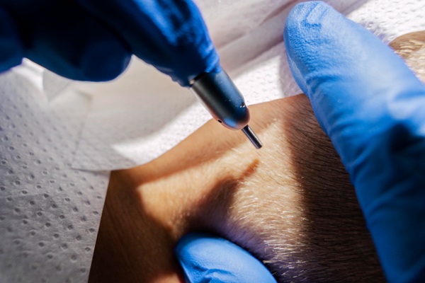 Injerto de barba - Médico tricólogo realizando un implante de barba a un hombre con vello facial escaso
