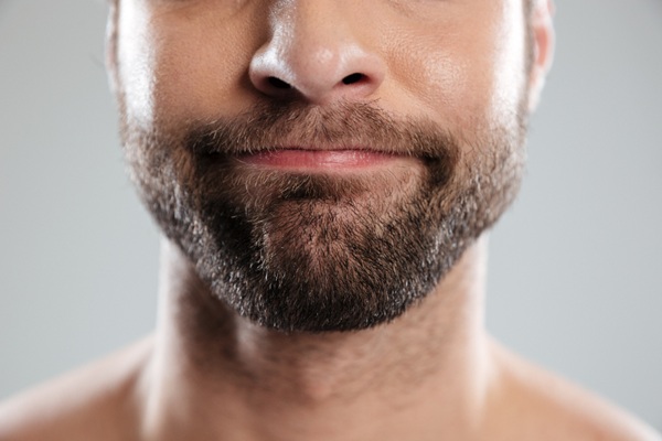 Injerto de barba - Hombre con barba abundante y natural gracias a los resultados del implante de barba