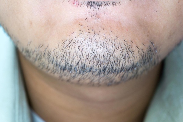 Hombre con vello facial en etapa de crecimiento luego del implante capilar