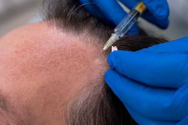 Médico especialista realizando un implante capilar a un hombre con alopecia en las entradas y cabello canoso