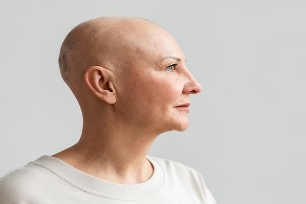 Pérdida de cabello por quimioterapia - mujer mayor con una fuerte calvicie por culpa de la quimioterapia