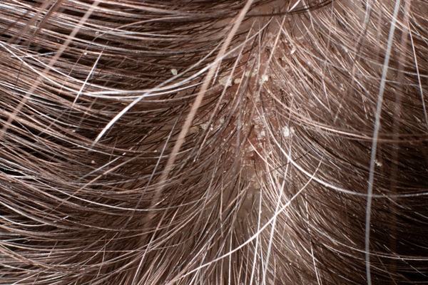 Problemas capilares distintos a la alopecia - Cuero cabelludo con presencia de pediculosis o piojos que causan picazón en el cabello