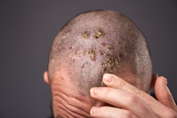 Hombre con erupciones y costras en el cuero cabelludo debido a la tinea capitis o tiña del cabello