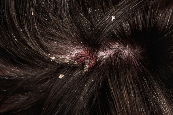 Vista superior del cabello de una persona con micosis del cuero cabello y foliculitis que causa picazón, enrojecimiento y costras blancas
