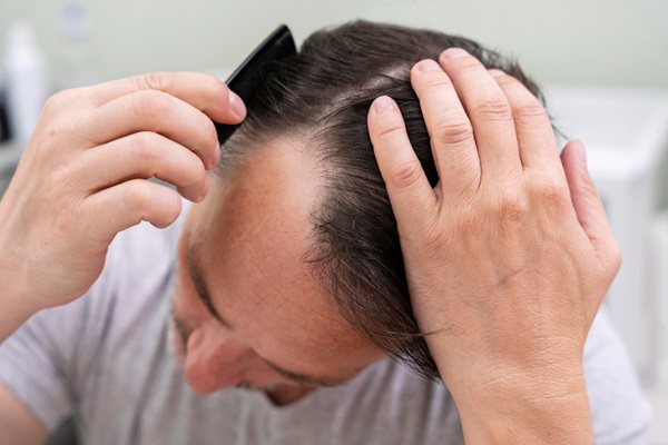 Hombre con pérdida de pelo en las entradas peinando su cabello con un peine