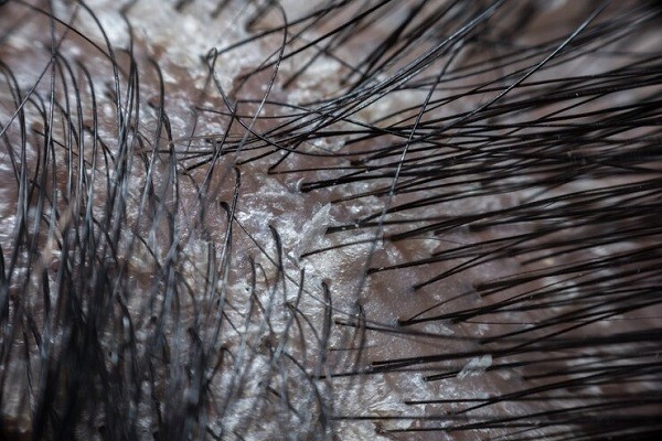 Caída del pelo con raíz blanca