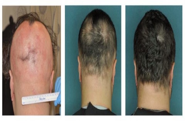 Inhibidores de JAK