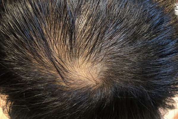 Láser de baja potencia - Vista superior del cuero cabelludo de un hombre con alopecia en al coronilla que necesita tratamientos capilares