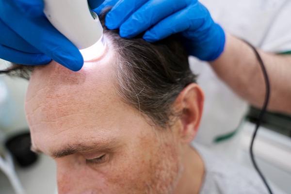 Láser de baja potencia - Tricólogo aplicando un tratamiento con luz de baja intensidad a un hombre con alopecia en las entradas para estimular el crecimiento capilar