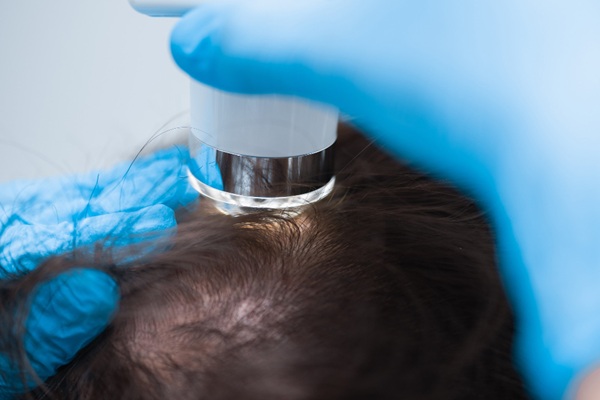 Médico especialista aplicando un tratamiento capilar a un hombre con alopecia para frenar la pérdida de cabello