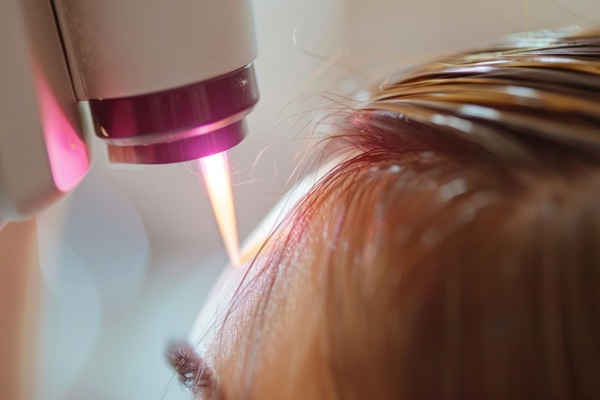 Mujer con pérdida de pelo sometiéndose a un tratamiento capilar para recuperar el cabello de manera natural