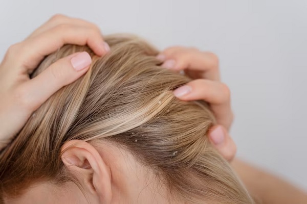 Remedios naturales para dermatitis seborreica